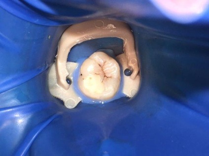 Endodontic kezelésére bölcsességfog - terápia - hírek és cikkek a fogászatban -