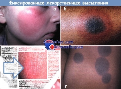 Erythema állandó gyógyszerszedés