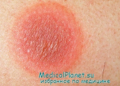 Erythema állandó gyógyszerszedés