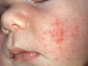 Erythema a gyermek tünetei, kezelés () Erythema a gyermek tünetei, kezelése
