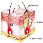 Pharyngitis fotó, tünetek és a kezelés minden típusú betegségek (pharyngitis) Torokgyulladás fotó, tünetei és kezelése minden típusú betegség