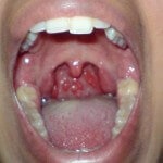 Pharyngitis fotó, tünetek és a kezelés minden típusú betegségek (pharyngitis) Torokgyulladás fotó, tünetei és kezelése minden típusú betegség