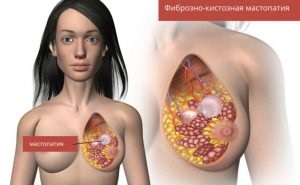 Fibrotikus breast mi ez, és hogyan kell kezelni (szálas) mell rostos mastopathia mi ez, és hogyan kell kezelni