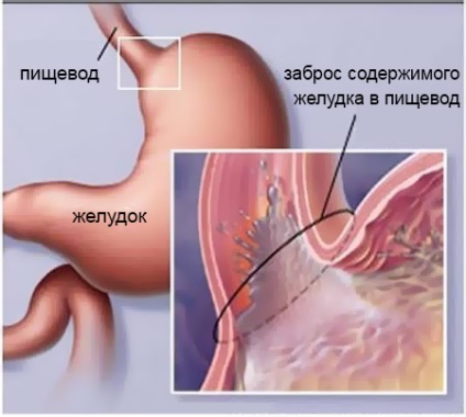 Gastrooesophagealis reflux betegség (GERD) (gyomor) Gastrooesophagealis reflux betegség (GERD)