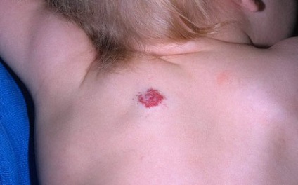 Hemangioma hátán gyermekek, újszülöttek és a felnőttek, a tünetek, okok, fájdalom, fotó (tumor) Hemangioma hátán gyermekek, újszülöttek és a felnőttek, a tünetek, okok, fájdalom, fotó