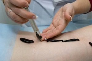 Hirudotherapy cukorbetegségben előnyök és ártalmak, ellenjavallatok, visszacsatolás (használat) Hirudotherapy cukorbetegségben előnyök és ártalmak, ellenjavallatok, vélemények