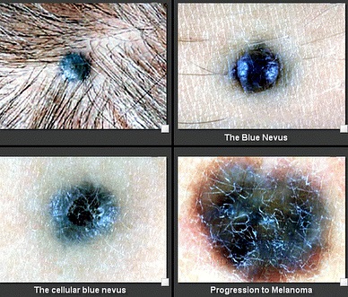 Blue anyajegyet is alakulnak a rák