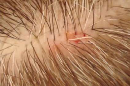 Грибок шкіри голови симптоми і лікування