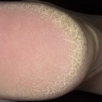 Gombák a nyomában - okai, tünetei és kezelése
