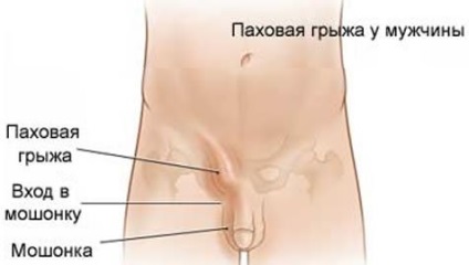 A porckorongsérv here férfiaknál fotó, hogyan kell kezelni (a here sérv férfiak) Sérv herében férfiaknál fotó, hogyan kell kezelni