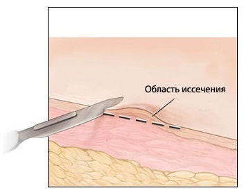 Tanulmány leírása biopszia, normál (hisztomorfológiai ellenőrzés diagnózis) A tanulmány a biopsziás anyag leírása, szabványok