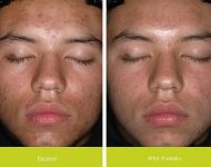 Ricinusolaj az arc tisztítása, vélemények fotókkal előtt és után