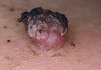 Ricinusolaj a papillomák (szemölcsök ricinusolaj) Ricinusolaj a papillomák