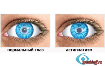 Keratometria olyan technikák (korai azonosítás) Keratometriával olyan technikák