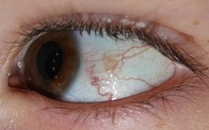 A kötőhártya ciszta fotó szemét betegségek és kezelések