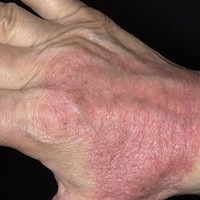 Tick ​​dermatitis sajátos megnyilvánulásainak kezelése