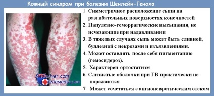 Clinic betegség Henoch-Schönlein purpura (Henoch-Schönlein purpura betegség klinika) Clinic betegség-Henoch purpura
