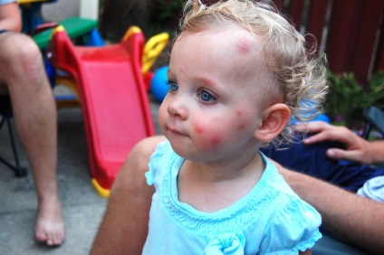 Szúnyogcsípés gyermekeknél - 7 módon, hogy enyhíti a viszketést és az allergia