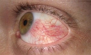 Red erek a szemében oka, hogy hogyan lehet megszabadulni a kezelés