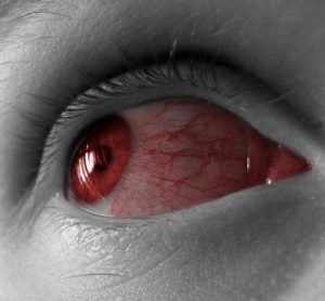 Red erek a szemében oka, hogy hogyan lehet megszabadulni a kezelés