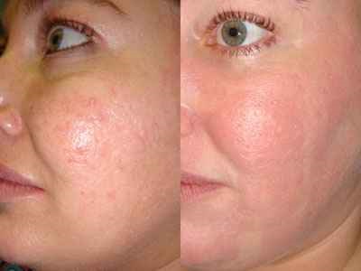 Rosacea krém véleménye az arcon (arc) Cream rosacea az arc vélemények