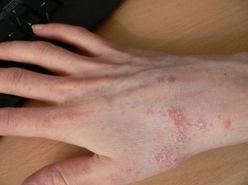Dermatitis kezelése a kézen népi jogorvoslati