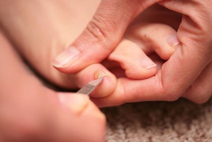 A kezelés a köröm gombás és láb ecet