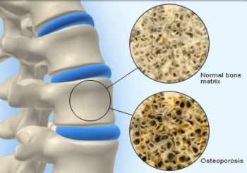 Osteoporosis kezelése az otthoni