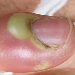 Лікування панариция пальця на руці і нозі в домашніх умовах