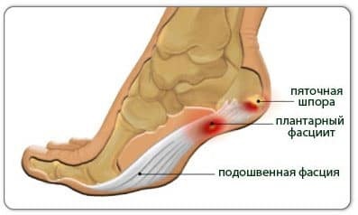 Kezelése sarkantyút a nyomában orvosi és népszerű (népi) A kezelés sarkantyú sarkára, és a nemzeti kábítószer-