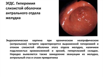 A limfoid hiperplázia antrális gyomornyálkahártya (nyálkahártya) A limfoid hiperplázia antrális gyomornyálkahártya