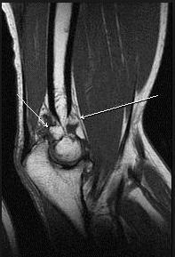 MRI a könyök