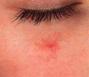 Kenőcs rosacea az arcon a leghatékonyabb eszköz, hogy megszüntesse seprűvénák (arc bőrpír) Kenőcs rosacea az arc a leghatékonyabb eszköz, hogy megszüntesse seprűvénák