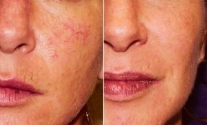 Kenőcs rosacea az arcon a leghatékonyabb eszköz, hogy megszüntesse seprűvénák (rosacea) Kenőcs rosacea az arc a leghatékonyabb eszköz, hogy megszüntesse seprűvénák