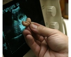 Lehetséges, hogy egy második abortusz (vetélés következményei a második) Lehetséges, hogy egy második abortusz