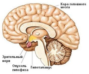MRI a hipofízis adenoma