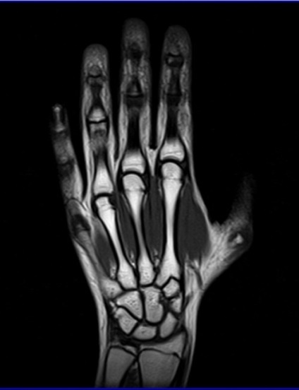 MRI Csuklóízület (MRI a csukló csukló és a kéz) MRI a Csuklóízület