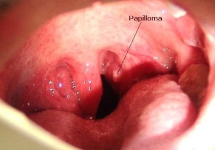 Növekedés az amygdala (papilloma) okai, tünetei és megelőzése