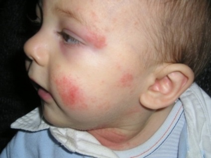 Az atópiás dermatitis gyermekkorban