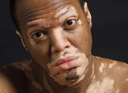A legújabb kezelési módszerek a vitiligo - az első orvosi