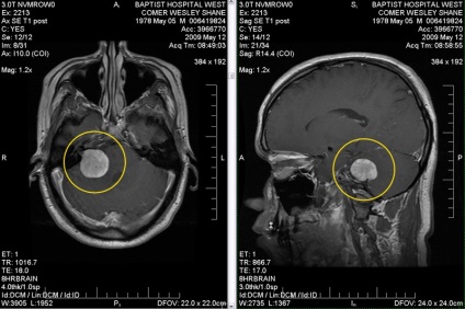 Működés az agydaganat és annak következményei, a modern klinikán kezelés nevrolgicheskih