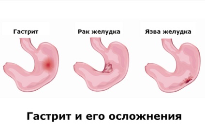Szövődmények, következményei és problémái gyomorhurut (gastritis) Szövődmények, következményei és problémái gyomorhurut