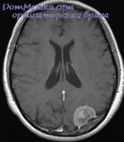 Agyvelő állományában a meningeómák (agyi parenchyma a meningiomák) Agyvelő állományában a meningiomák