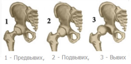 Frejka párna minta - dysplasia sürgős intézkedések