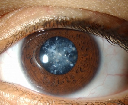 Cataract szem és a kezelés (fényelnyelése a szem) elhomályosulása a szemlencse és a kezelés