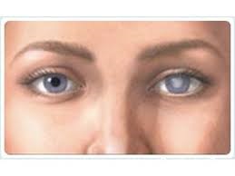 Cataract szem okok, tünetek, kezelés