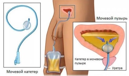 Következmények és válaszok eltávolítása férfiaknál a húgyhólyag