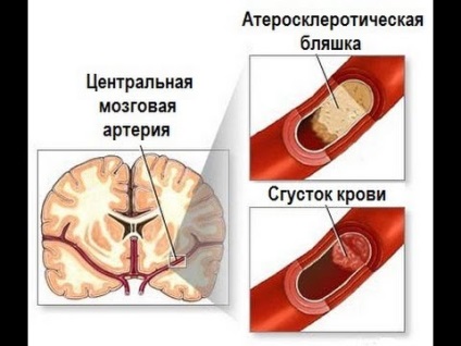 Ismétlődő stroke prognózisa, a következmények és hány ember él