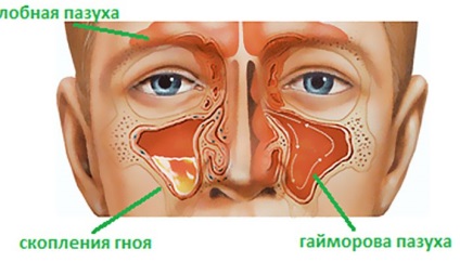 Jobb oldali arcüreggyulladás tünetei és kezelése