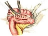 Jobb oldali hemicolectomy 2 (csatlakozik a vékonybélben) Jobb oldali hemicolectomy 2